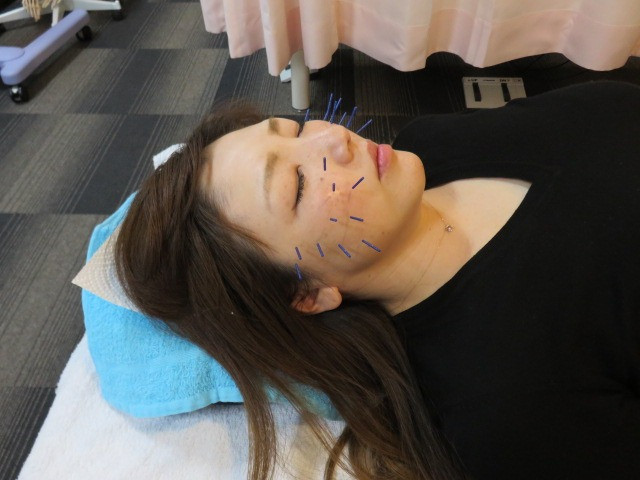 近所でお気軽美顔鍼(美容鍼)!堺市西区の「リィ~ン」
